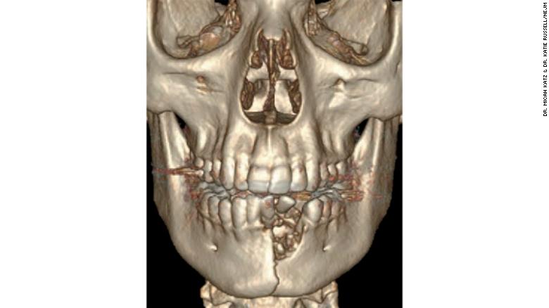 A CT scan of the 17-year-old boy, featuring his shattered jaw and displaced teeth.