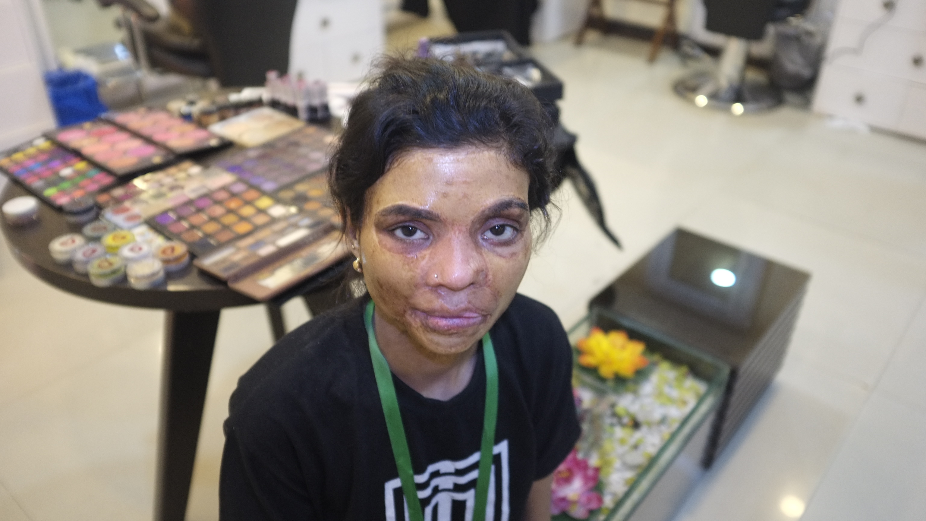 Artificial skin trial offers hope to Pakistan's acid attack victims