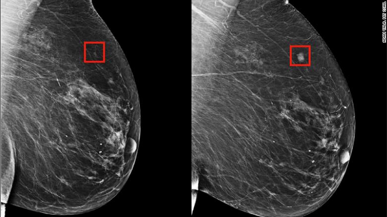 An algorithm, developed by MIT researchers, could identify a woman&#39;s risk of breast cancer and help to catch it early