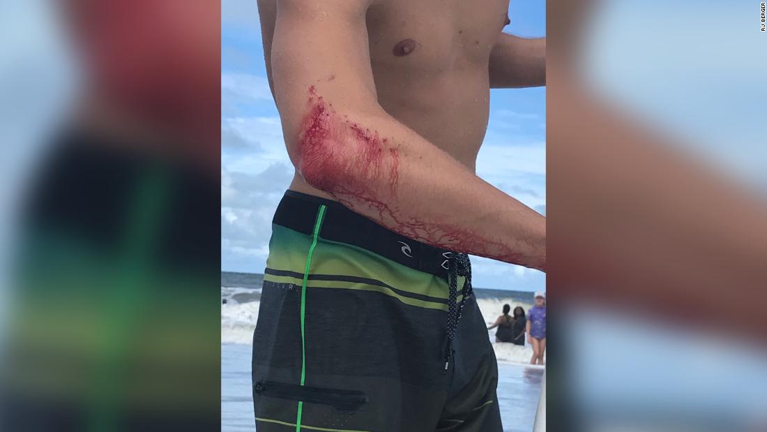 Florida Surfer Bitten By Shark Near Jacksonville Beach Cnn Video