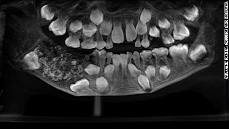 An x-ray of the boy&#39;s mouth