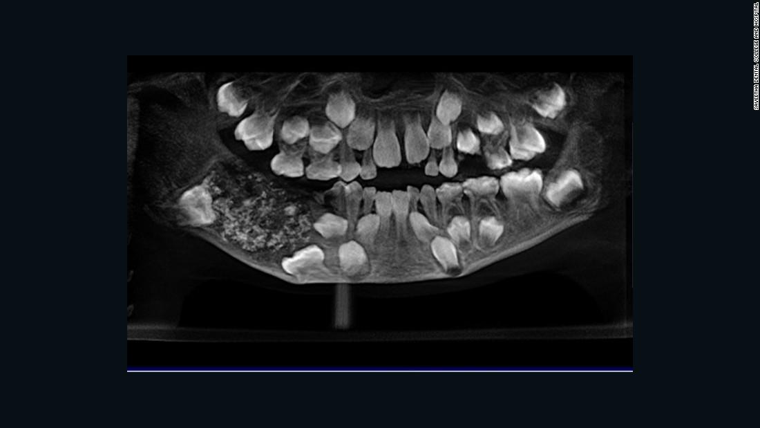 Doctors Find 526 Teeth In Boy S Mouth In India Cnn