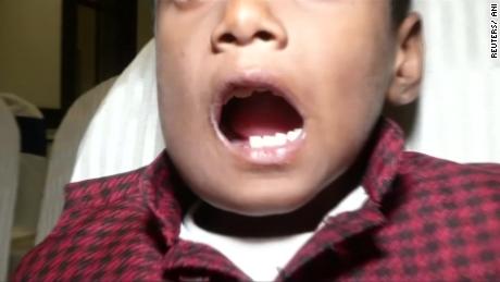 More Than 500 Teeth Removed From Boy S Mouth In India Cnn Video