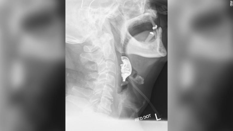 The X-ray showed a semicircular object lying across the man&#39;s vocal cords.