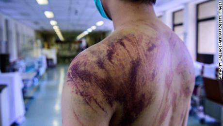 Calvin So, 23, a resident of Yuen Long, a Hong Kong town near the border with mainland China, shows his wounds and bruises on July 24, 2019, after he was assaulted on his way home by a gang of men.