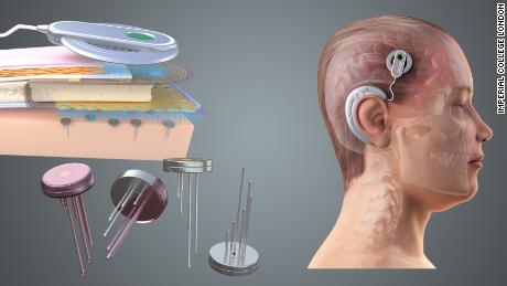 Neural interfaces may offer a new way of treating conditions including dementia, paralysis, mental health conditions or obesity, according to new research.