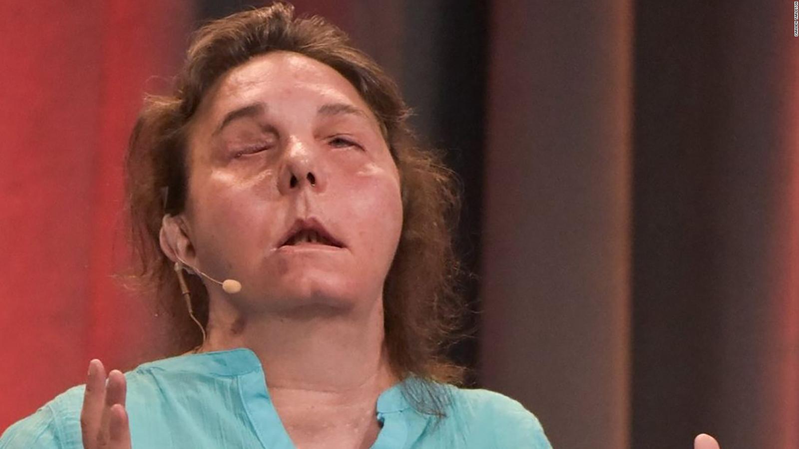 New Hampshire Woman Becomes First American To Undergo Two Face 7966