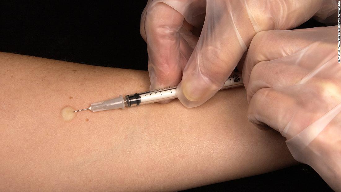 16 students in Indiana were accidentally injected with insulin during a TB test, school district says