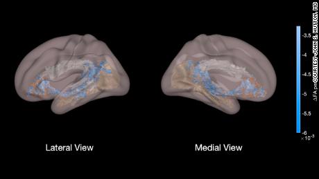 This view shows the three major tracts involved with language and literacy skills: the arcuate fasciculus, shaded in white, which connects brain areas involved with receptive and expressive language. The one in brown supports rapid naming of objects, and the one in beige, visual imagery. The blue color illustrates lower measures of white matter development in children using excessive screen time.