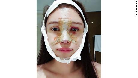 A photo of Wu Xiaochen just after one of her multiple nose surgeries.