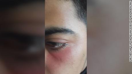  The 17-year-old Syrian refugee suffered a minor injury to his face and eye after the assault, according to the Partnership for the Advancement of New Americans. 