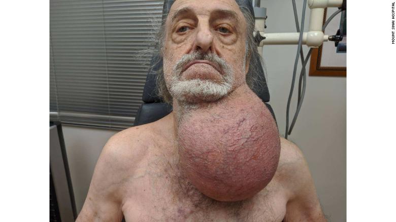 The man&#39;s tumor as seen before surgery.
