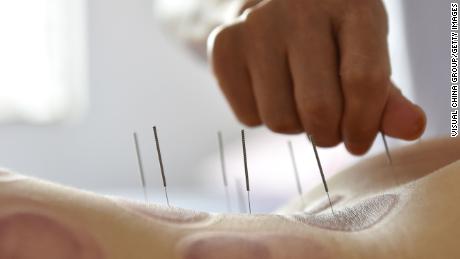 Acupuncture therapy in Hong Kong was linked to organ and tissue injuries, infection and other adverse reactions by a 2018 study.