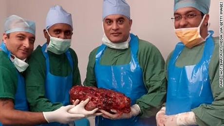 Doctors of Sir Ganga Ram Hospital, in New Delhi, claimed to have removed India&#39;s heaviest kidney weighing 7.4 kilograms.