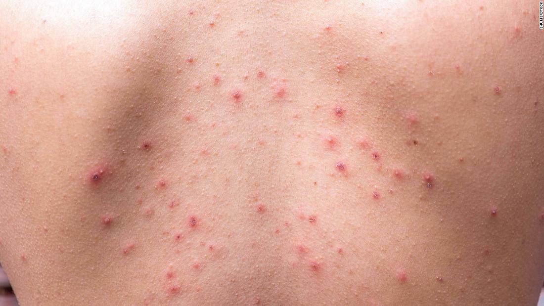 Chicken Pox Vaccine For Adults Near Me