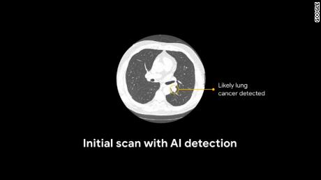 AI detection scan used for lung cancer malignancy prediction. 
