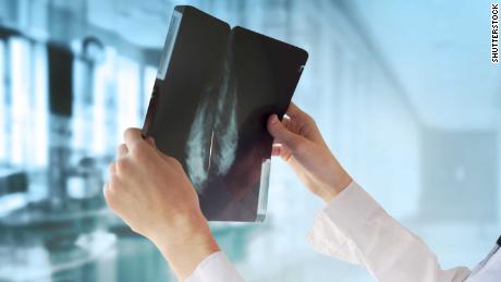 Breast cancer tops lung cancer as most diagnosed cancer in the world, report says