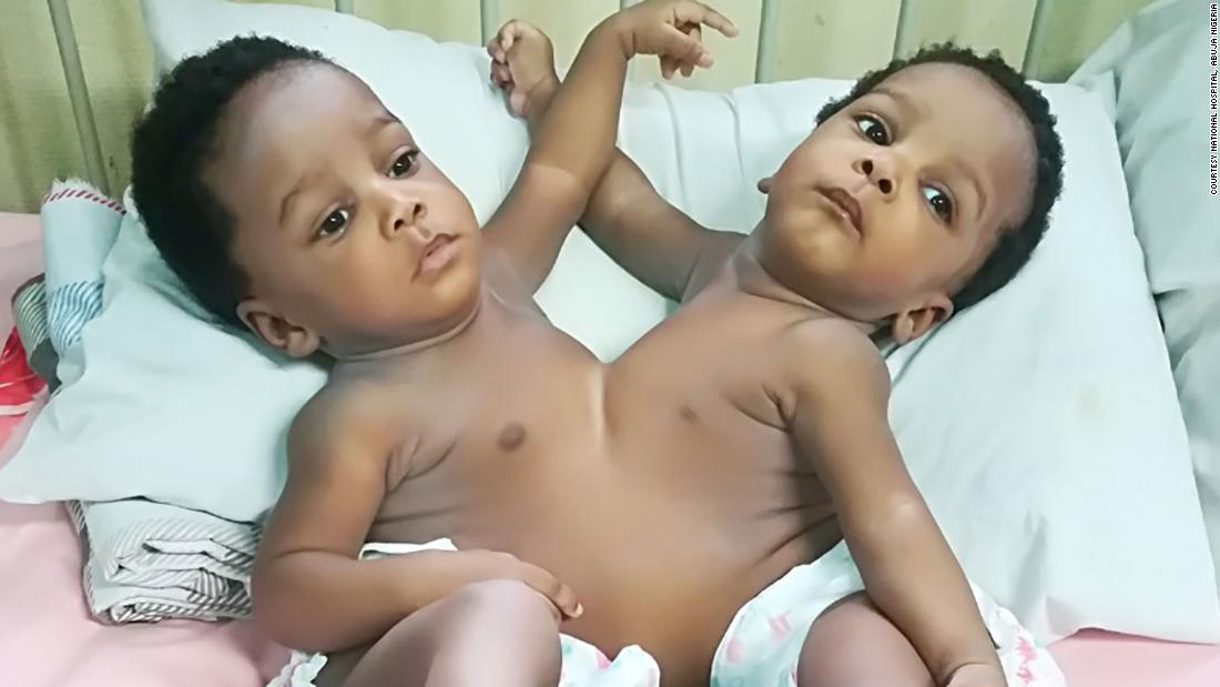Conjoined twins successfully separated by 78-member team.