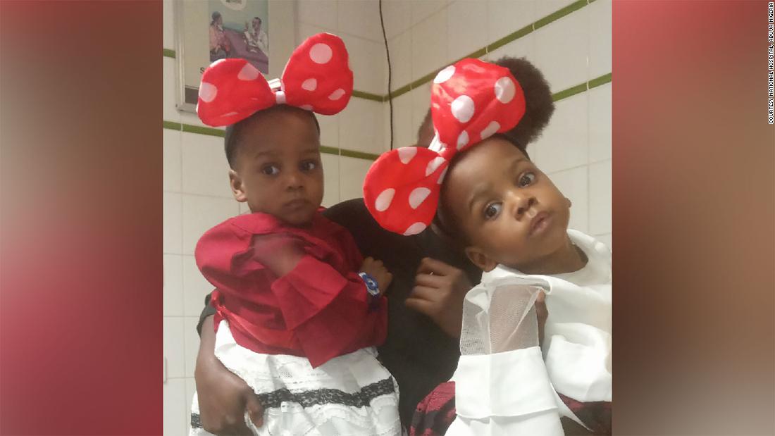 Nigerian Sisters Conjoined At The Chest And Abdomen Separated And Ready 6291