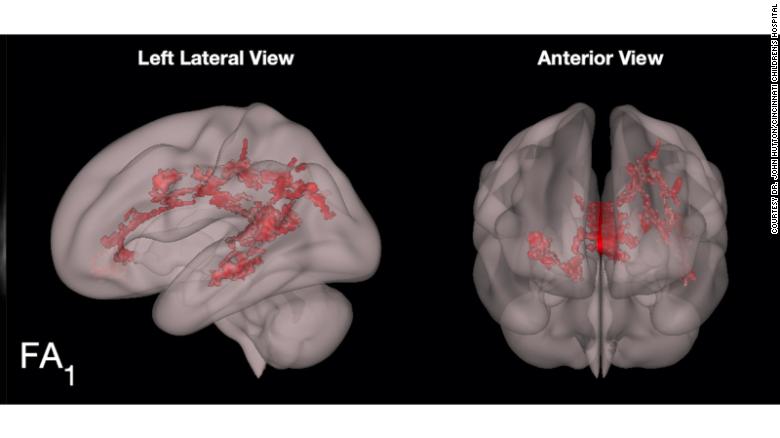 The red shows the increase in organzied white matter in the language centers of the preschooler's brain.