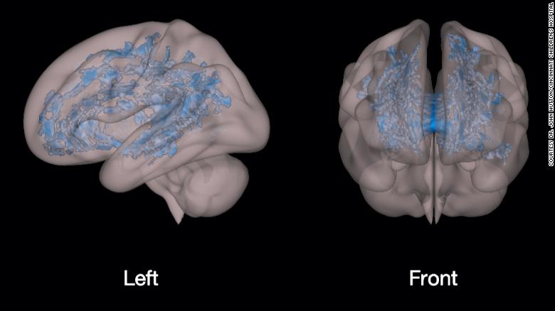The blue shows the massive underdevelopment and disorganization of white matter in a preschooler who is using a screen (television, tablets and smartphones, etc.)