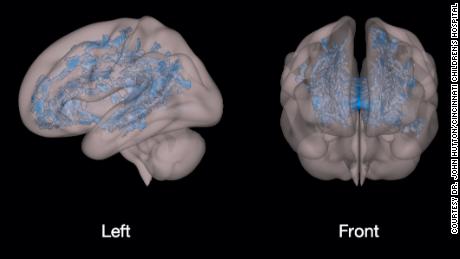 The blue shows the massive underdevelopment and disorganization of white matter in a preschooler who is using a screen (television, tablets and smartphones, etc.)