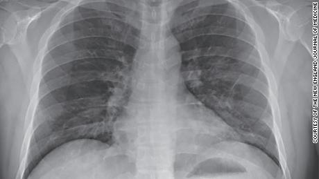 200131121336 01 washington coronavirus patient lungs large 169