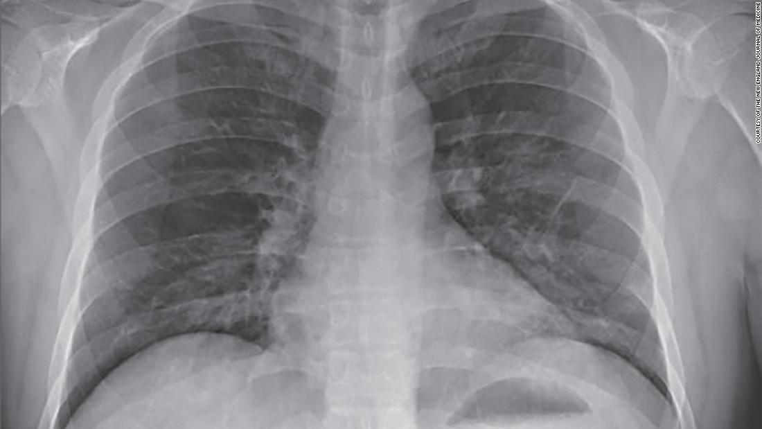 Файл cxr corona как открыть