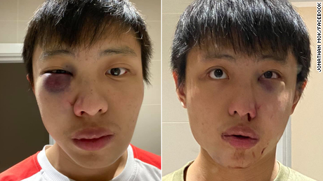 Jonathan Mok said he was attacked in London, causing injury to his right eye. He posted two photos of his face on social media, explaining: &quot;One image was taken in the mirror and hence, the laterally inverted image. The image that seems so be much swollen was taken as a selfie-- and the bruising only developed in the following day.&quot;