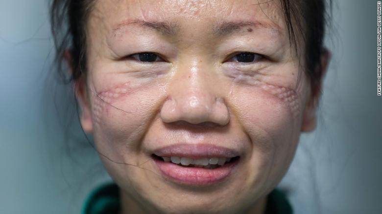 The marks of a mask are seen on the face of nurse Cao Shan after working in the isolation ward in Jinyintan Hospital, designated for Covid-19 patients, in Wuhan, China.
