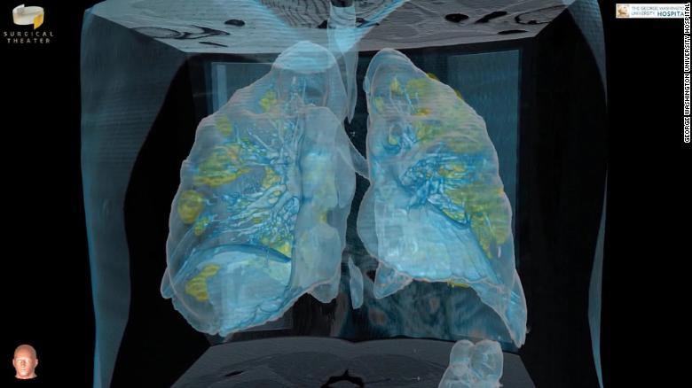 3-D video shows Covid-19 attack patient's lungs