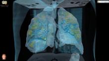 Silent hypoxia: Covid-19 patients who should be gasping for air but aren&#39;t