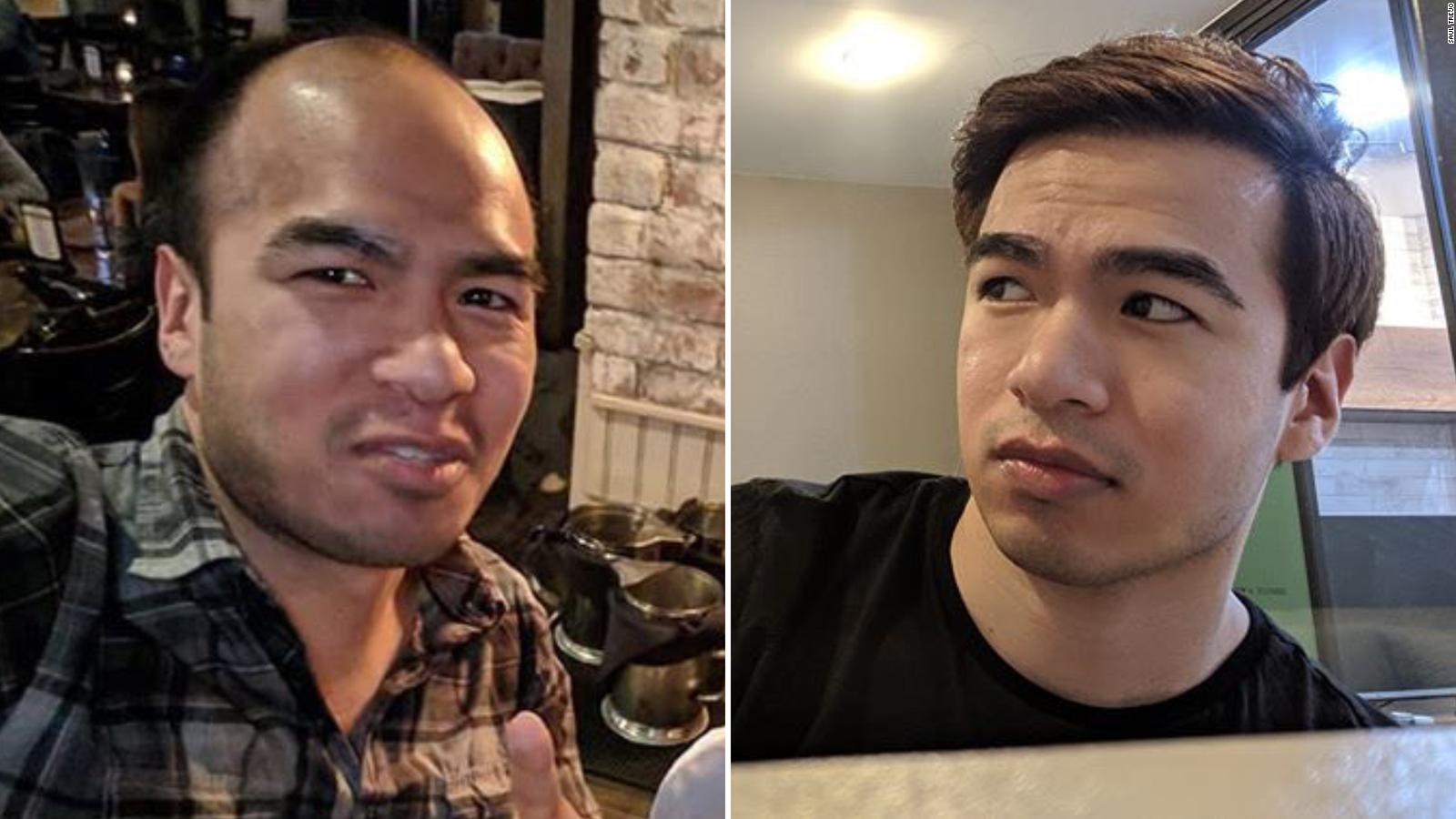 reddit hair loss treatment