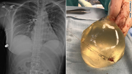 Doctors believe the woman&#39;s life was saved because of her implants, which affected the trajectory of the bullet.