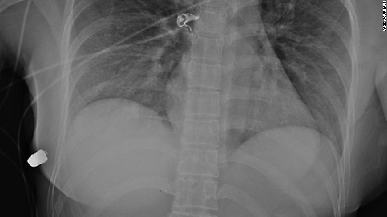 An X-ray showing the bullet in the lateral thoracic wall.