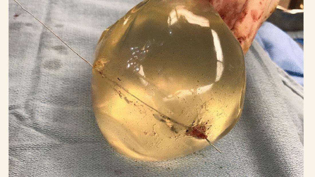 Womans Breast Implant Deflects Bullet Saving Her Life Cnn