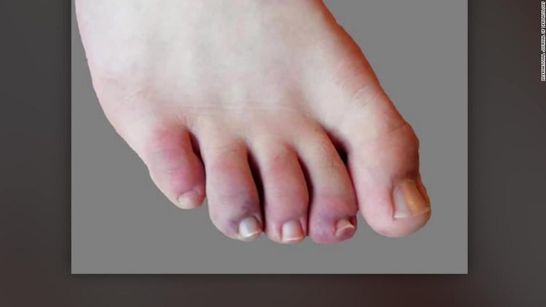Get Covid Toes Symptoms Painful Background
