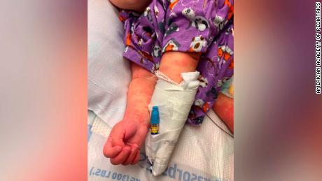 Kids with suspected Covid-related syndrome need immediate attention, doctors say