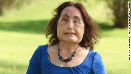 Connie Culp, the first person to receive a near-total face transplant in the US, has died 