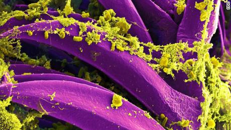 A California resident has been diagnosed with plague for the first time in five years