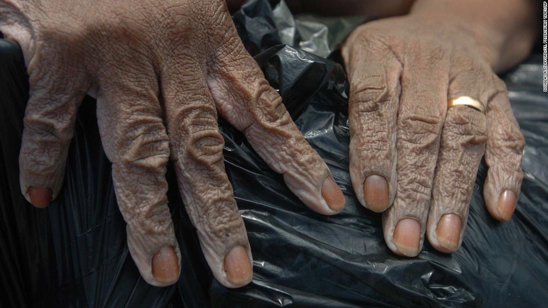 The hands of Shirley Ward, 40, are waterlogged after she was rescued on New Orleans&#39; Rocheblave Street.