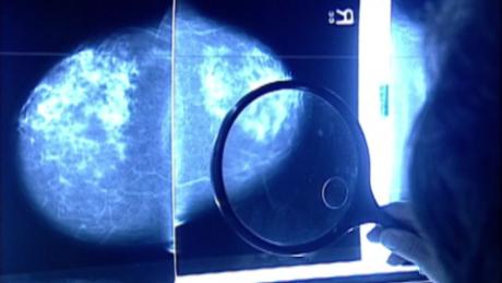 Targeted therapy shows benefit for people with advanced breast cancer in late-stage trial