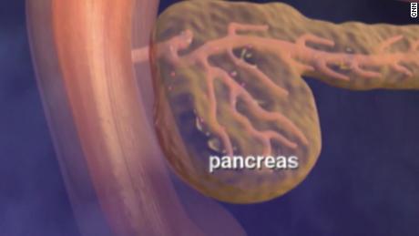 Why pancreatic cancer is so deadly