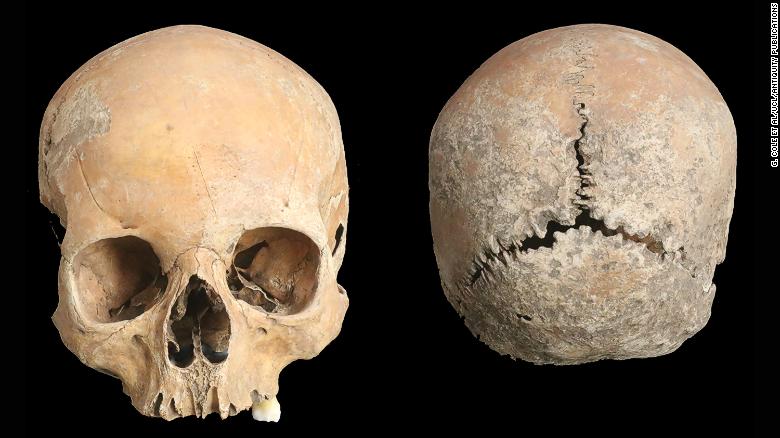 An Anglo-Saxon girl had her nose and lips cut off as punishment, an ancient skull shows