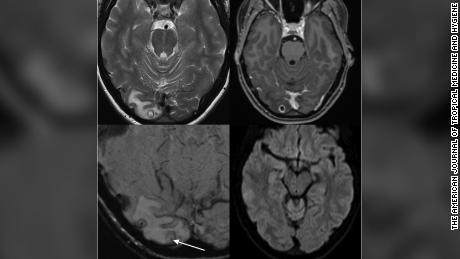 An MRI showed a cyst in the woman&#39;s brain which was found to contain tapeworm larvae. 
