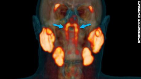 PSMA PET/CT indicated a previously unnoticed pared nasopharyngeal macroscopic salivary gland.