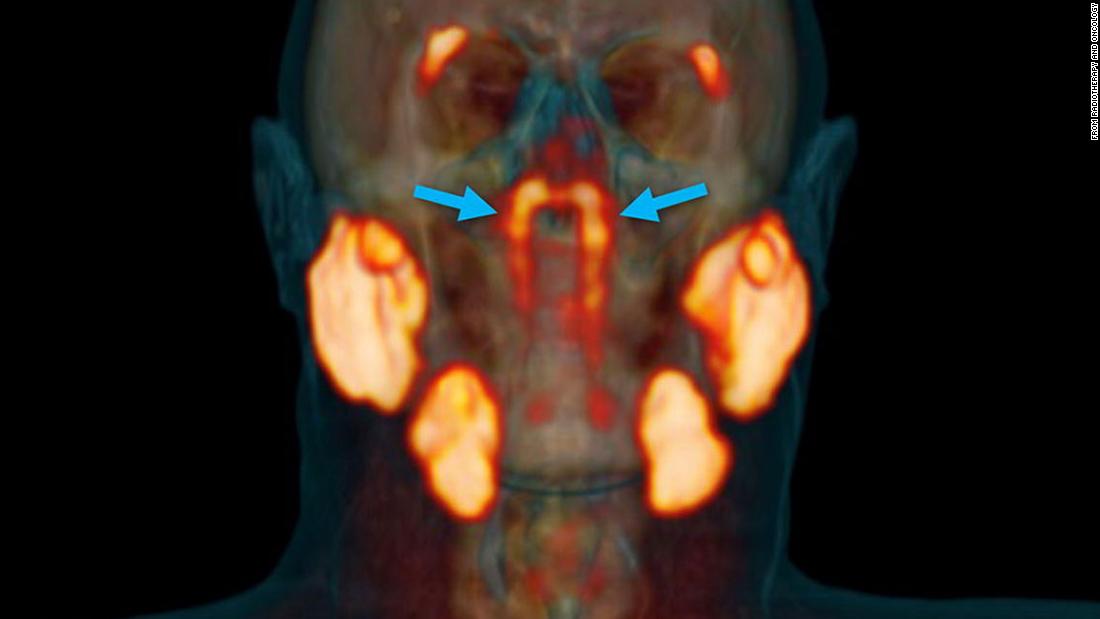 Possible new organ may be found in the throat: duodenal salivary glands