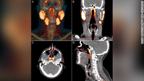 This overview of salivary gland tissue as seen on PSMA PET / CT scans depicts the known major salivary glands and an unknown structure (indicated by arrows) in the nasopharynx. 