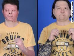 Man receives first successful face and double hand transplant