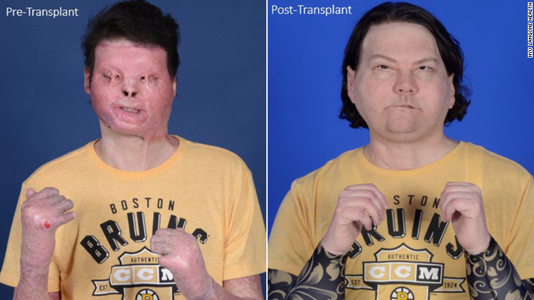 World’s first face and hands transplant gives New Jersey man a second chance at life